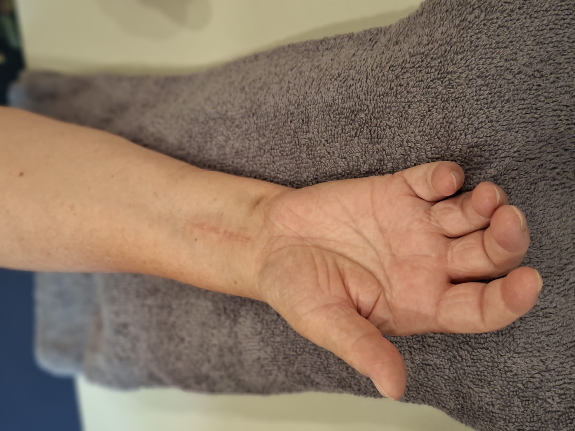 Narbe am Handgelenk nach einer Operation